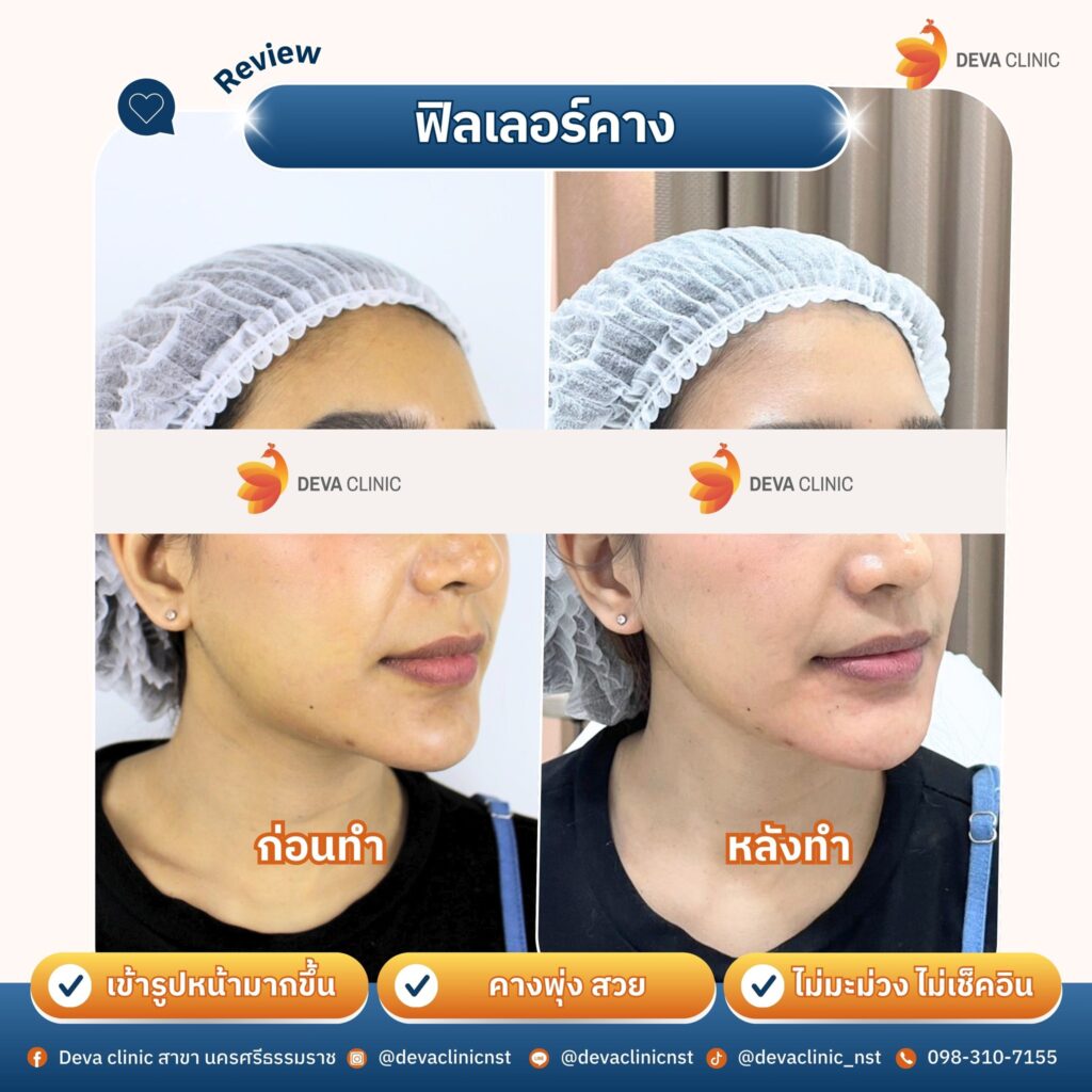 filler แก้คางไม่ละมุน เติมขอบคาง