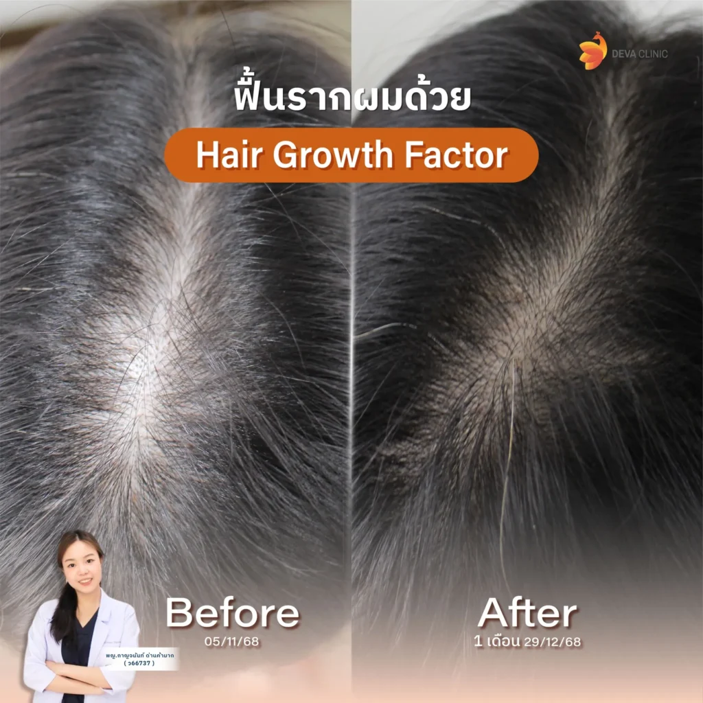 hair growth factor 5