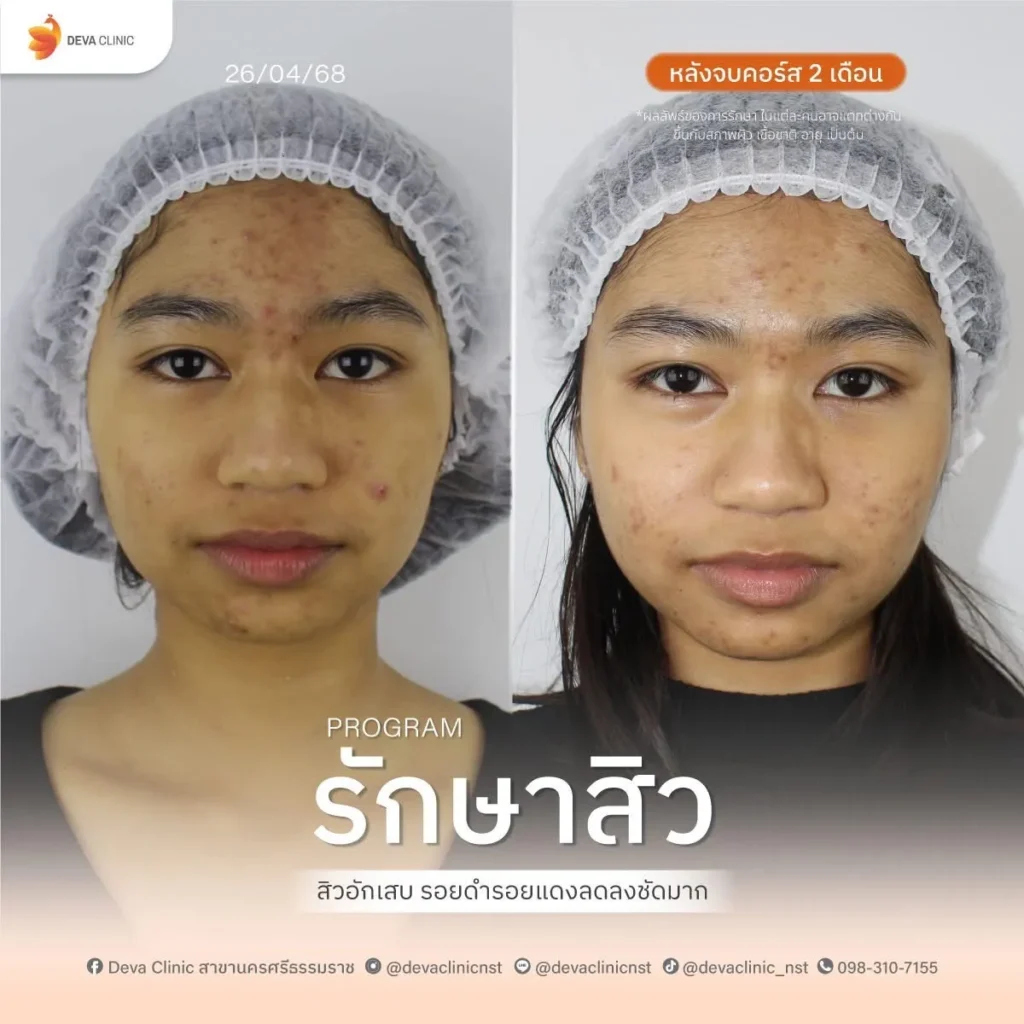 รักษาสิว 2