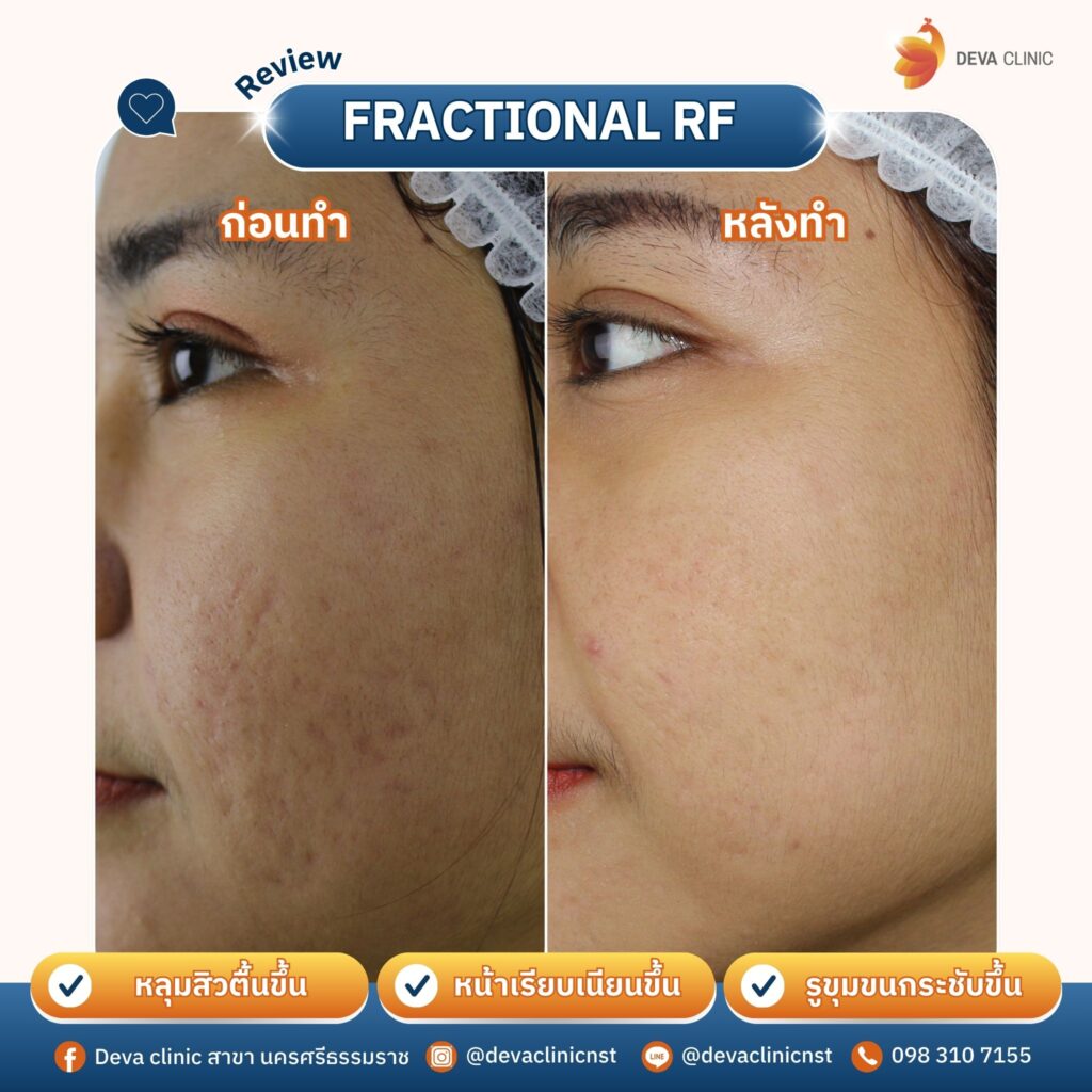 รักษาหลุมสิว 2