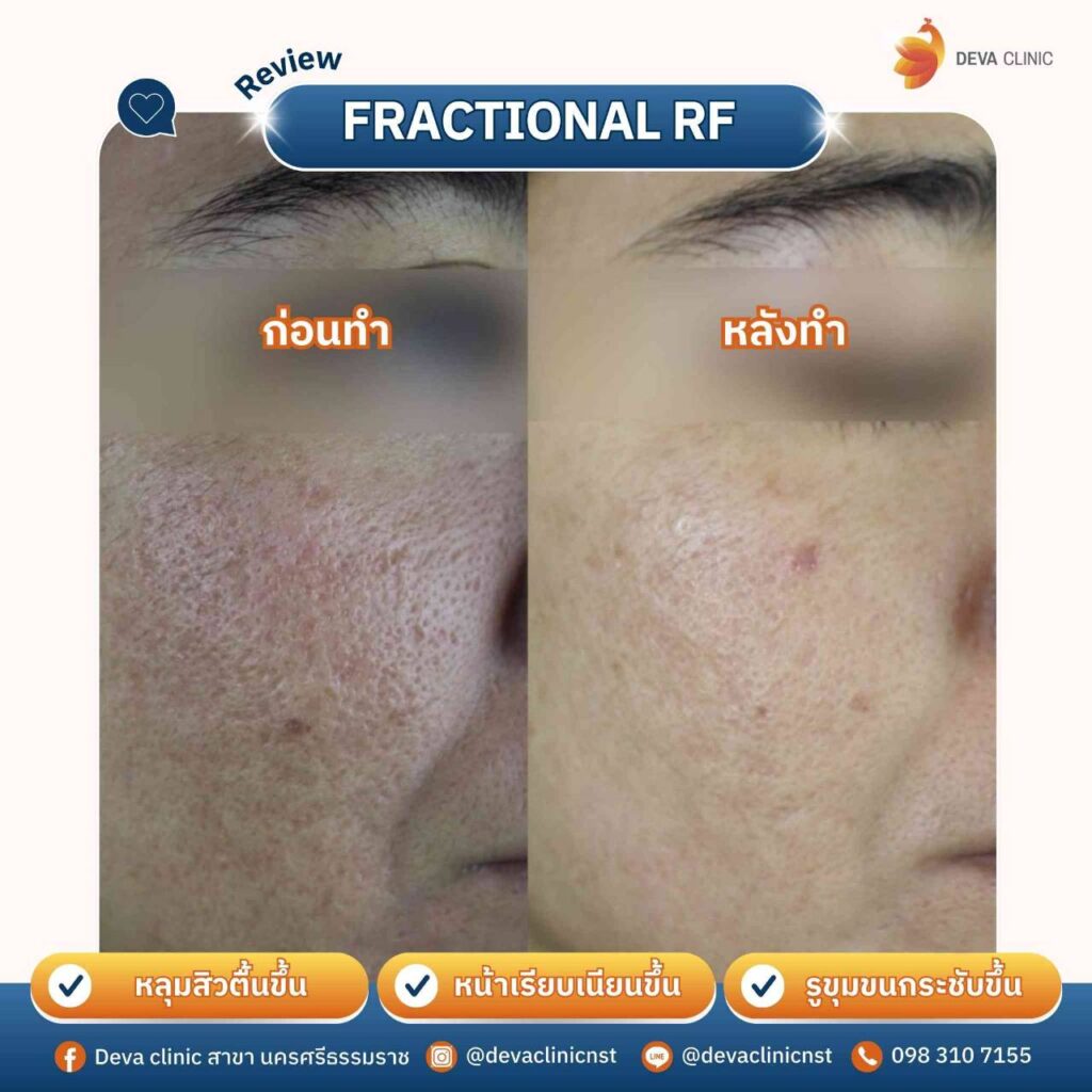 รักษาหลุมสิว 5