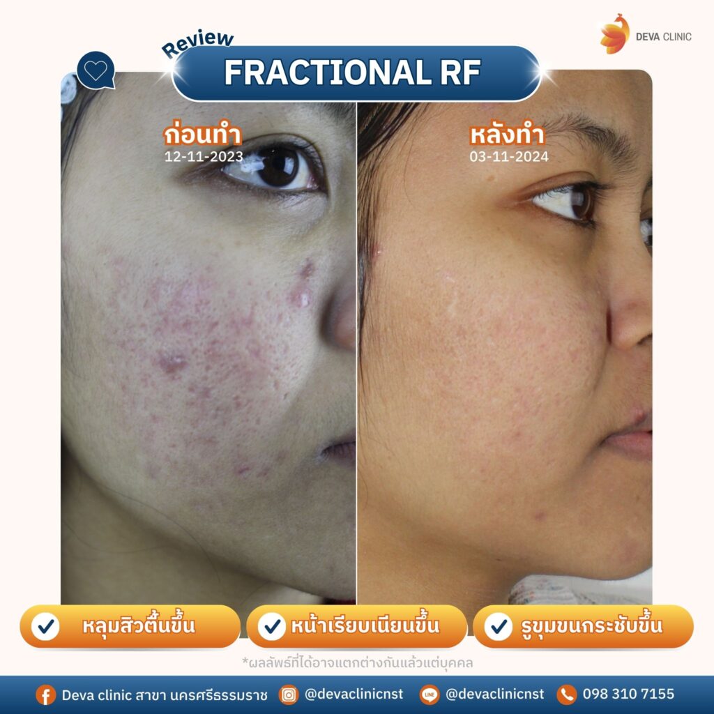 รักษาหลุมสิว 8