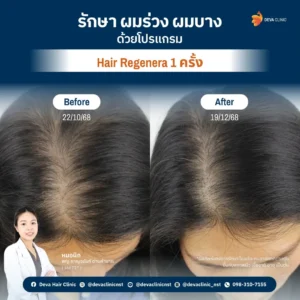 hair regenera6